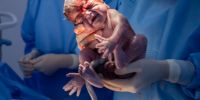 Labour & Birthing Complications